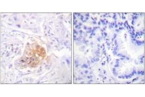Immunohistochemistry analysis of paraffin-embedded human lung carcinoma tissue, using IL-2R beta/CD122 (Ab-364) Antibody. (IL2 Receptor beta Antikörper  (AA 331-380))