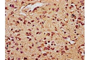 IHC image of ABIN7172459 diluted at 1:300 and staining in paraffin-embedded human glioma performed on a Leica BondTM system. (HNF1B Antikörper  (AA 539-704))