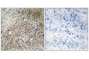 Immunohistochemistry analysis of paraffin-embedded human prostate carcinoma tissue using A26C2/3 antibody. (POTEG Antikörper)