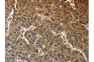 The image on the left is immunohistochemistry of paraffin-embedded Human liver cancer tissue using ABIN7128585(ATP1B2 Antibody) at dilution 1/30, on the right is treated with fusion protein. (ATP1B2 Antikörper)