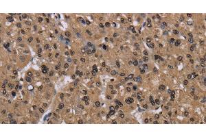 Immunohistochemistry of paraffin-embedded Human liver cancer using CSNK2A1 Polyclonal Antibody at dilution of 1:30 (CSNK2A1/CK II alpha Antikörper)