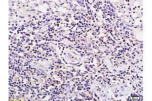 Formalin-fixed and paraffin embedded rat xenograft tumor tissue labeled with Anti SPP24/SPP2 Polyclonal Antibody, Unconjugated (ABIN1385317) followed by conjugation to the secondary antibody and DAB staining (SPP2 Antikörper  (AA 55-160))