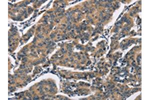The image on the left is immunohistochemistry of paraffin-embedded Human breast cancer tissue using ABIN7192349(SH2B2 Antibody) at dilution 1/30, on the right is treated with synthetic peptide. (SH2B2 Antikörper)