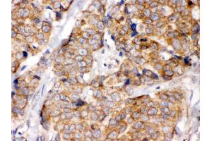 Anti- eIF4A2 Picoband antibody, IHC(P) IHC(P): Human Mammary Cancer Tissue (EIF4A2 Antikörper  (N-Term))
