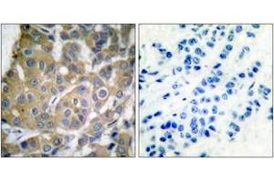 Immunohistochemistry analysis of paraffin-embedded human breast carcinoma tissue, using Cox2 Antibody. (COX2 Antikörper  (AA 555-604))