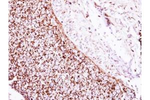 IHC-P Image Immunohistochemical analysis of paraffin-embedded human breast cancer, using Glutamate Dehydrogenase, antibody at 1:250 dilution. (GLUD1 Antikörper)