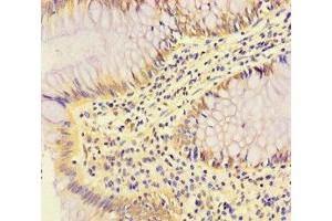 Immunohistochemistry of paraffin-embedded human colon cancer using ABIN7166969 at dilution of 1:100