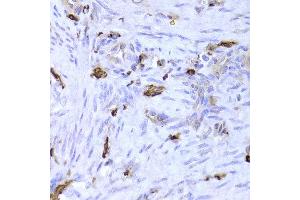 Immunohistochemistry of paraffin-embedded Human adenomyosis using LSP1 antibody at dilution of 1:100 (x400 lens). (LSP1 Antikörper)