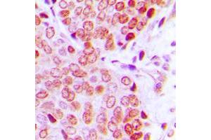 Immunohistochemical analysis of ZNF134 staining in human prostate cancer formalin fixed paraffin embedded tissue section. (ZNF134 Antikörper  (Center))