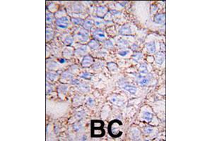 Formalin-fixed and paraffin-embedded human breast carcinoma tissue reacted with MAPK15 polyclonal antibody  , which was peroxidase-conjugated to the secondary antibody, followed by DAB staining. (MAPK15 Antikörper  (N-Term))
