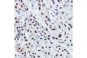 Immunohistochemistry of paraffin-embedded human esophageal cancer using [KO Validated] NCO Rabbit pAb (ABIN6129656, ABIN6144413, ABIN6144414 and ABIN7101354) at dilution of 1:100 (40x lens). (NCOA2 Antikörper  (AA 550-820))