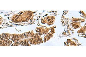 Immunohistochemistry of paraffin-embedded Human colorectal cancer tissue using PDCD5 Polyclonal Antibody at dilution of 1:55(x200) (PDCD5 Antikörper)