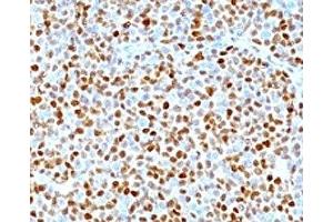 Formalin-fixed, paraffin-embedded human mantle cell lymphoma stained with CCND1 antibody. (Cyclin D1 Antikörper)