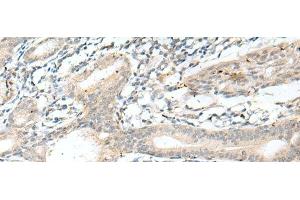 Immunohistochemistry of paraffin-embedded Human esophagus cancer tissue using NXNL1 Polyclonal Antibody at dilution of 1:45(x200) (NXNL1 Antikörper)