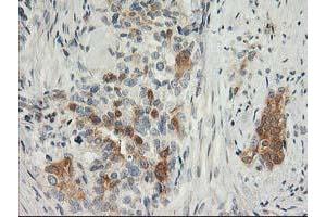 Immunohistochemical staining of paraffin-embedded Adenocarcinoma of Human breast tissue using anti-SNAP25 mouse monoclonal antibody. (SNAP25 Antikörper)