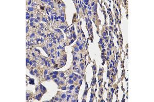 Immunohistochemistry of paraffin-embedded mouse lung cancer using KLRD1 antibody at dilution of 1:200 (x400 lens)