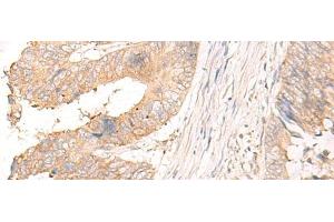 Immunohistochemistry of paraffin-embedded Human colorectal cancer tissue using MYDGF Polyclonal Antibody at dilution of 1:25(x200) (MYDGF Antikörper)