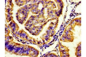 Immunohistochemistry of paraffin-embedded human endometrial cancer using ABIN7142644 at dilution of 1:100 (HTR7 Antikörper  (AA 1-83))