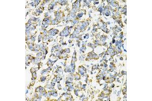 Immunohistochemistry of paraffin-embedded human lung cancer using ADSS antibody (ABIN6292806) at dilution of 1:100 (40x lens). (ADSS Antikörper)