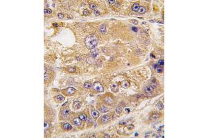 Formalin-fixed and paraffin-embedded human hepatocarcinoma tissue reacted with LDLR antibody (C-term) (ABIN392554 and ABIN2842101) , which was peroxidase-conjugated to the secondary antibody, followed by DAB staining. (LDLRAP1 Antikörper  (C-Term))