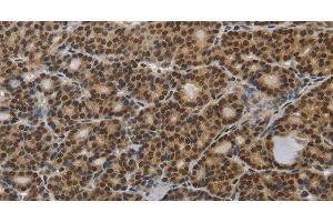 Immunohistochemistry of paraffin-embedded Human thyroid cancer tissue using SMAD7 Polyclonal Antibody at dilution 1:40 (SMAD7 Antikörper)