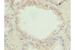 Immunohistochemistry of paraffin-embedded human prostate cancer using ABIN7158525 at dilution of 1:100 (ACSBG1 Antikörper  (AA 351-600))
