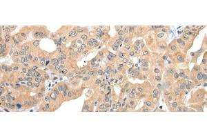 Immunohistochemistry of paraffin-embedded Human thyroid cancer tissue using CAGE1 Polyclonal Antibody at dilution of 1:35(x200) (CAGE1 Antikörper)