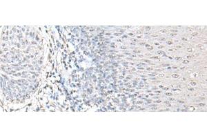 Immunohistochemistry of paraffin-embedded Human esophagus cancer tissue using EPM2A Polyclonal Antibody at dilution of 1:55(x200) (EPM2A Antikörper)