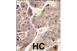 Formalin-fixed and paraffin-embedded human hepatocarcinoma tissue reacted with PIK3R3 antibody (C-term), which was peroxidase-conjugated to the secondary antibody, followed by DAB staining.