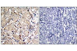 Immunohistochemical analysis of paraffin-embedded human breast carcinoma tissue using FKHR(Phospho-Ser319) Antibody(left) or the same antibody preincubated with blocking peptide(right). (FOXO1 Antikörper  (pSer319))