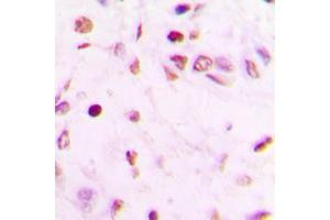 Immunohistochemical analysis of GATA4 staining in human lung cancer formalin fixed paraffin embedded tissue section. (GATA4 Antikörper  (Center))
