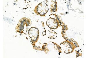ABIN6258437 and ABIN6274598 at 1/100 staining Human colorectal cancer by IHC-P.