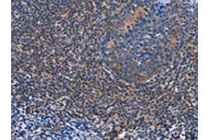 The image on the left is immunohistochemistry of paraffin-embedded Human tonsil tissue using ABIN7128290(AGFG1 Antibody) at dilution 1/60, on the right is treated with fusion protein. (AGFG1 Antikörper)