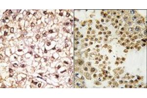 (LEFT)Formalin-fixed and paraffin-embedded human cancer tissue reacted with the primary antibody, which was peroxidase-conjugated to the secondary antibody, followed by AEC staining. (Parkin Antikörper  (N-Term))