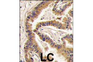 Formalin-fixed and paraffin-embedded human lung carcinoma tissue reacted with CSNK1A1 polyclonal antibody  , which was peroxidase-conjugated to the secondary antibody, followed by DAB staining. (CSNK1A1 Antikörper  (C-Term))