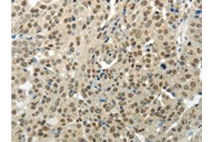 The image on the left is immunohistochemistry of paraffin-embedded Human breast cancer tissue using ABIN7189956(BAZ1B Antibody) at dilution 1/35, on the right is treated with synthetic peptide. (BAZ1B Antikörper)