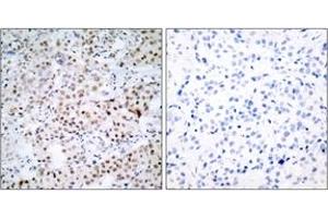 Immunohistochemistry analysis of paraffin-embedded human breast carcinoma tissue, using CREB (Ab-133) Antibody. (CREB1 Antikörper  (AA 100-149))