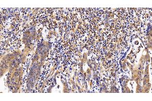 Detection of LIFR in Human Stomach cancer Tissue using Polyclonal Antibody to Leukemia Inhibitory Factor Receptor (LIFR) (LIFR Antikörper  (AA 522-691))