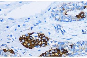 Immunohistochemistry of paraffin-embedded Human mammary cancer using EEA1 Polyclonal Antibody at dilution of 1:100 (40x lens). (EEA1 Antikörper)