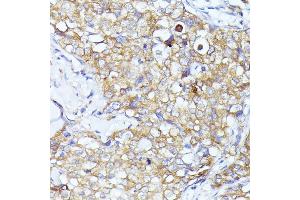 Immunohistochemistry of paraffin-embedded human mammary cancer using EIF3L antibody (ABIN6131772, ABIN6140074, ABIN6140075 and ABIN6225315) at dilution of 1:100 (40x lens). (EIF3L Antikörper  (AA 1-230))