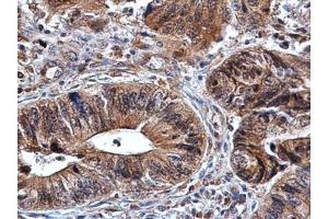 IHC-P Image Amphiregulin antibody detects Amphiregulin protein at cytoplasm in human colon cancer by immunohistochemical analysis. (Amphiregulin Antikörper)