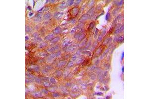 Immunohistochemical analysis of CG beta staining in human breast cancer formalin fixed paraffin embedded tissue section.