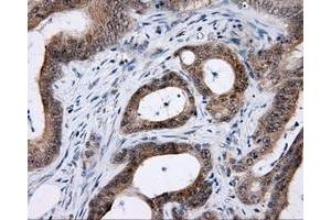 Immunohistochemical staining of paraffin-embedded Carcinoma of prostate tissue using anti-LIPG mouse monoclonal antibody. (LIPG Antikörper)