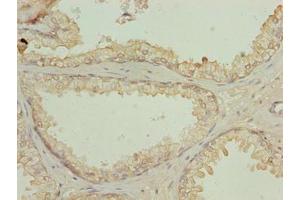Immunohistochemistry of paraffin-embedded human prostate cancer using ABIN7161122 at dilution of 1:100 (N4BP2L2 Antikörper  (AA 1-300))