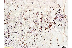 Formalin-fixed and paraffin embedded human breast carcinoma labeled with Anti-MCP-2 Polyclonal Antibody, Unconjugated (ABIN676283) at 1:200 followed by conjugation to the secondary antibody and DAB staining (CCL8 Antikörper  (AA 24-99))