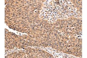 The image on the left is immunohistochemistry of paraffin-embedded Human lung cancer tissue using ABIN7193106(ZNF146 Antibody) at dilution 1/20, on the right is treated with synthetic peptide. (ZNF146 Antikörper)
