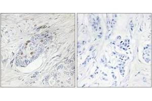 Immunohistochemistry analysis of paraffin-embedded human breast carcinoma, using ZNF232 Antibody. (ZNF232 Antikörper  (AA 171-220))