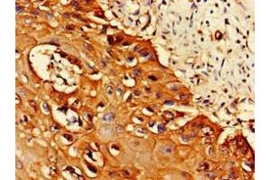 Immunohistochemistry of paraffin-embedded human cervical cancer using ABIN7164944 at dilution of 1:100 (PSMA1 Antikörper  (AA 163-263))