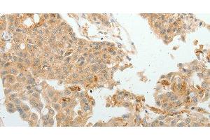 Immunohistochemistry of paraffin-embedded Human lung cancer tissue using ASCL1 Polyclonal Antibody at dilution 1:30 (ASCL1 Antikörper)