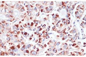 Immunohistochemistry of paraffin-embedded Human liver cancer using TFRC Polyclonal Antibody at dilution of 1:100 (40x lens). (Transferrin Receptor Antikörper)